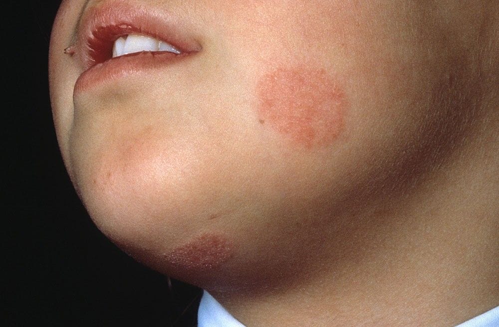 Infeksi, Jamur, Ringworm