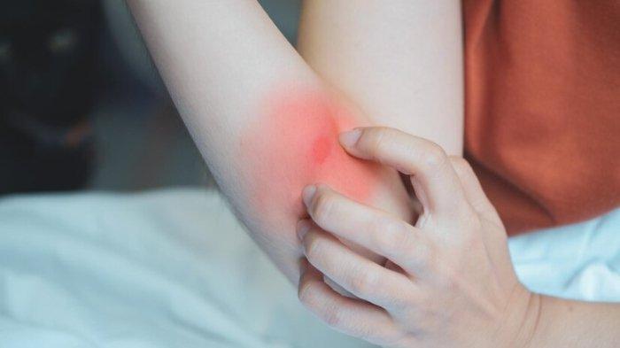 Jamur, kuku, Ringworm