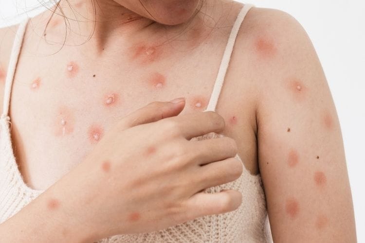 Cacar Monyet, Kemenkes, monkeypox