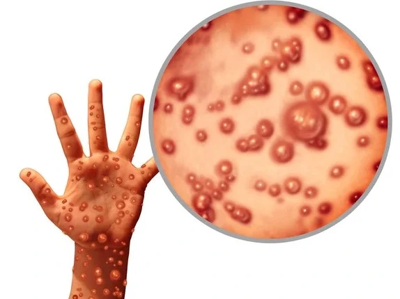 Cacar Monyet, monkeypox, MPOX