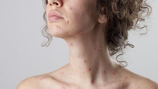 Cacar Air, Cacar Monyet, Kesehatan, MPOX