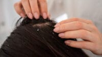 Ketombe rambut, kulit kepala kering, penyebab ketombe, cara atasi ketombe, shampoo pelembap, jarang keramas, keramas berlebihan, ketombe kering, kesehatan rambut, konsultasi dokter, masalah kulit kepala, perawatan rambut sehat, kondisi medis ketombe, minyak alami rambut.