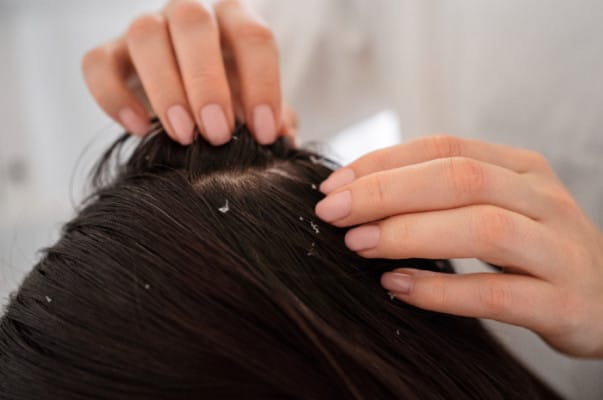 Ketombe rambut, kulit kepala kering, penyebab ketombe, cara atasi ketombe, shampoo pelembap, jarang keramas, keramas berlebihan, ketombe kering, kesehatan rambut, konsultasi dokter, masalah kulit kepala, perawatan rambut sehat, kondisi medis ketombe, minyak alami rambut.
